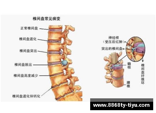 腰椎间盘突出困扰：体育明星如何面对挑战与康复之路